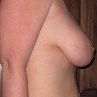 Thu gọn quầng vú cho vòng 1 khổng lồ