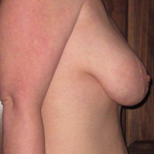 Thu gọn quầng vú cho vòng 1 khổng lồ