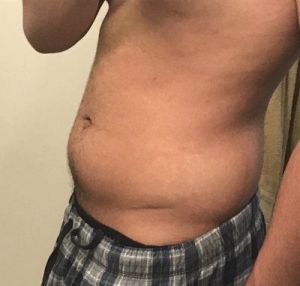 Tôi có phải là ứng viên phù hợp với hút mỡ VASER không? Nam giới 21 tuổi đã giảm 33 kg