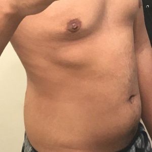 Tôi có phải là ứng viên phù hợp với hút mỡ VASER không? Nam giới 21 tuổi đã giảm 33 kg