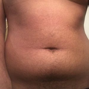 Tôi có phải là ứng viên phù hợp với hút mỡ VASER không? Nam giới 21 tuổi đã giảm 33 kg