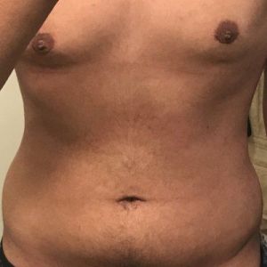 Tôi có phải là ứng viên phù hợp với hút mỡ VASER không? Nam giới 21 tuổi đã giảm 33 kg