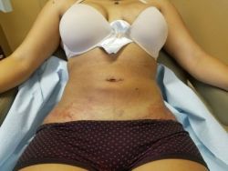 Tụ dịch sau khi hút mỡ VASER 2 ngày