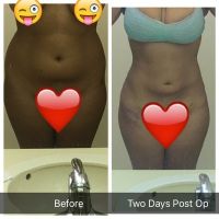 Tụ dịch sau khi hút mỡ VASER 2 ngày