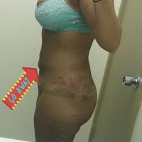 Tụ dịch sau khi hút mỡ VASER 2 ngày