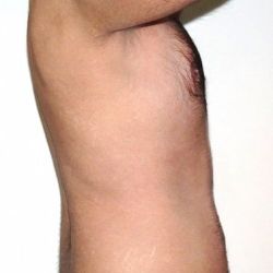 Liệu những vết bỏng do băng ép sau hút mỡ có bình thường không