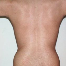 Liệu những vết bỏng do băng ép sau hút mỡ có bình thường không