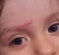 Cách điều trị sẹo lồi cho trẻ em