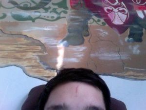 Cách xử lý vết sẹo dọc trên trán