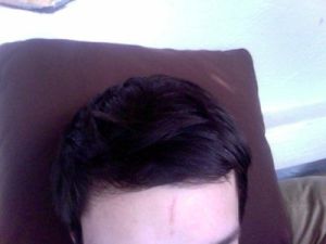 Cách xử lý vết sẹo dọc trên trán