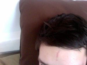 Cách xử lý vết sẹo dọc trên trán