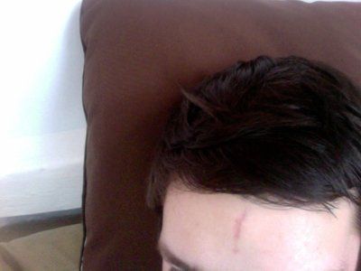 Cách xử lý vết sẹo dọc trên trán Cách xử lý vết sẹo dọc trên trán