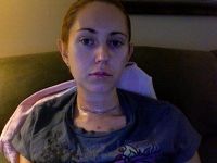 Trị sẹo để lại sau khi mổ tuyến giáp