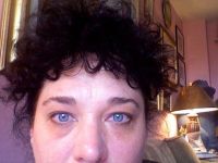 Mí mắt sưng và xệ sau khi tiêm Botox