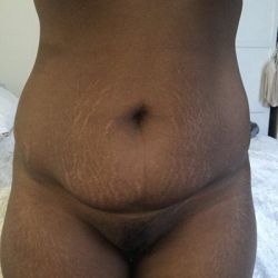 Nên giảm cân hay tăng cân trước khi nâng mông và tạo hình thành bụng?