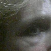 Sưng và bầm tím sau khi tiêm Botox