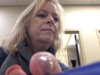 Tình trạng sưng sau khi tiêm Kybella kéo dài bao lâu?