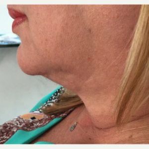 Bệnh nhân 52 tuổi sau tiêm Kybella