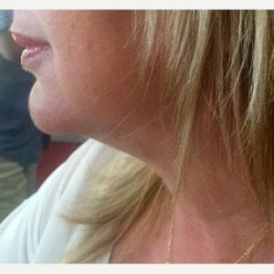 Bệnh nhân 52 tuổi sau tiêm Kybella