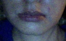 Khi nào có thể uống rượu trở lại sau khi tiêm Botox và Restylane?