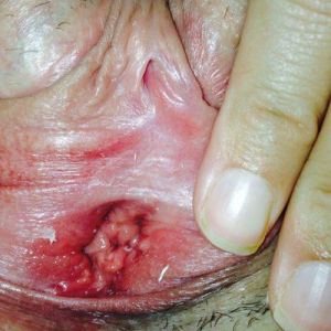 Vùng kín của tôi có bình thường không? có cần trẻ hóa âm đạo không?