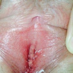 Vùng kín của tôi có bình thường không? có cần trẻ hóa âm đạo không?