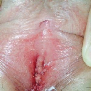 Vùng kín của tôi có bình thường không? có cần trẻ hóa âm đạo không?