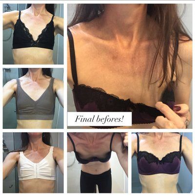 Nâng ngực bằng túi độn gel silicon 275cc dáng tròn, vỏ trơn, độ nhô trung bình cộng ở phụ nữ 36 tuổi