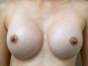 Nâng ngực bằng túi độn gel silicon 275cc dáng tròn, vỏ trơn, độ nhô trung bình cộng ở phụ nữ 36 tuổi