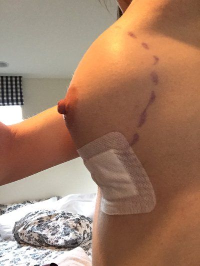 Nâng ngực bằng túi độn gel silicon 275cc dáng tròn, vỏ trơn, độ nhô trung bình cộng ở phụ nữ 36 tuổi