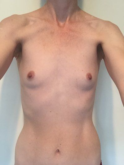 Nâng ngực bằng túi độn gel silicon 275cc dáng tròn, vỏ trơn, độ nhô trung bình cộng ở phụ nữ 36 tuổi