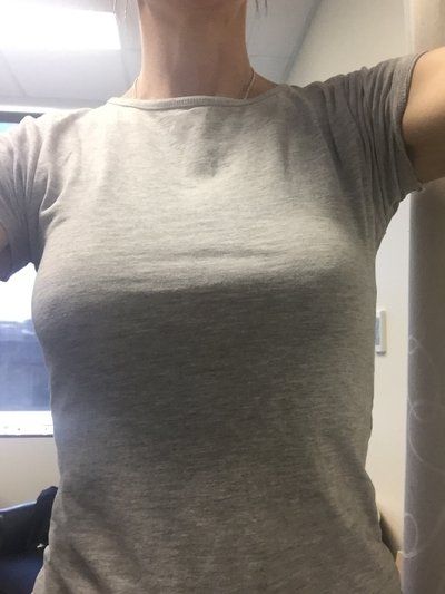 Nâng ngực bằng túi độn gel silicon 275cc dáng tròn, vỏ trơn, độ nhô trung bình cộng ở phụ nữ 36 tuổi