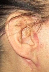 Cách sửa dái tai dính liền với mặt sau khi căng da mặt?