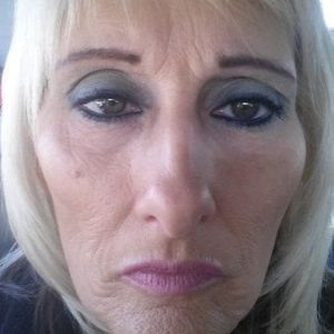 Nên tiêm filler hay căng da mặt?