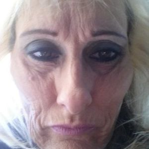 Nên tiêm filler hay căng da mặt?