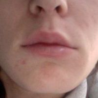 Môi sưng và không cân sau khi tiêm filler Juvederm- có phải bình thường không? Môi sưng và không cân sau khi tiêm filler Juvederm- có phải bình thường không?