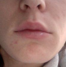 Môi sưng và không cân sau khi tiêm filler Juvederm- có phải bình thường không?