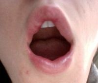 Môi sưng và không cân sau khi tiêm filler Juvederm- có phải bình thường không? Môi sưng và không cân sau khi tiêm filler Juvederm- có phải bình thường không?