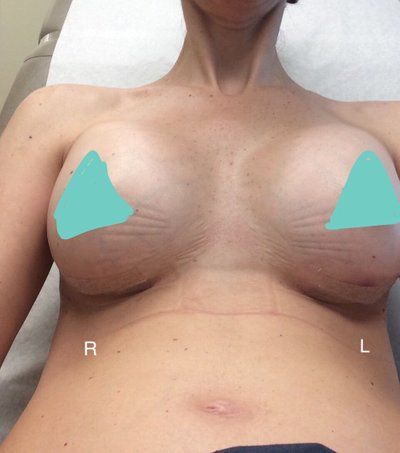 Nâng ngực với túi gel silicon natrelle, độ nhô trung bình ở bà mẹ 2 con cao 1m79, nặng 59 kg