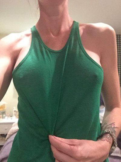 Nâng ngực bằng túi độn gel silicon 275cc dáng tròn, vỏ trơn, độ nhô trung bình cộng ở phụ nữ 36 tuổi