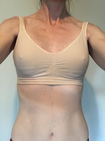 Nâng ngực bằng túi độn gel silicon 275cc dáng tròn, vỏ trơn, độ nhô trung bình cộng ở phụ nữ 36 tuổi