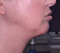 Nên chọn Kybella, Ultherapy hay hút mỡ?