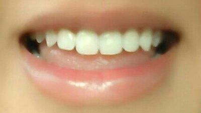 Kết quả niềng răng six month smile mang lại cho mình