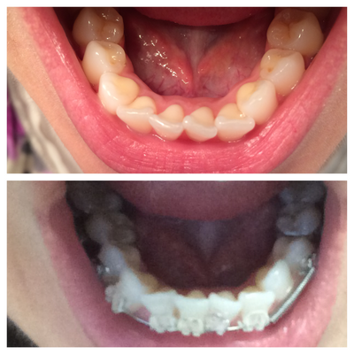 Niềng răng ở tuổi 28