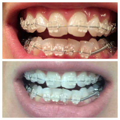 Niềng răng ở tuổi 28