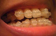 Trải nghiệm về quá trình niềng răng