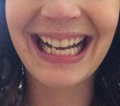 Hành trình niềng răng ở tuổi 22