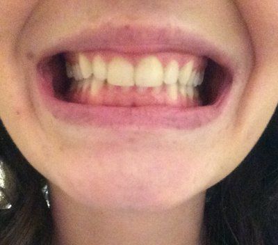 Hành trình niềng răng ở tuổi 22