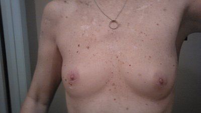 Mẹ đơn thân mắc ung thư da vẫn quyết tâm nâng ngực sau khi đã hoàn thành việc nuôi dạy 2 con
