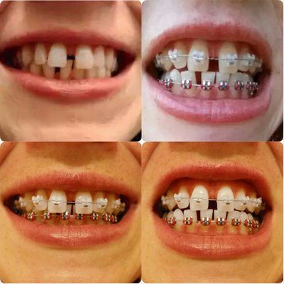 Niềng răng để khắc phục răng thưa